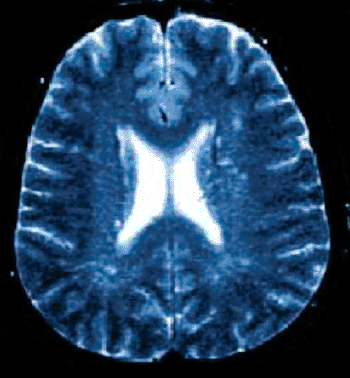 Image: Magnetic resonance image of cerebral white matter lesions (Photo courtesy of University of Barcelona.